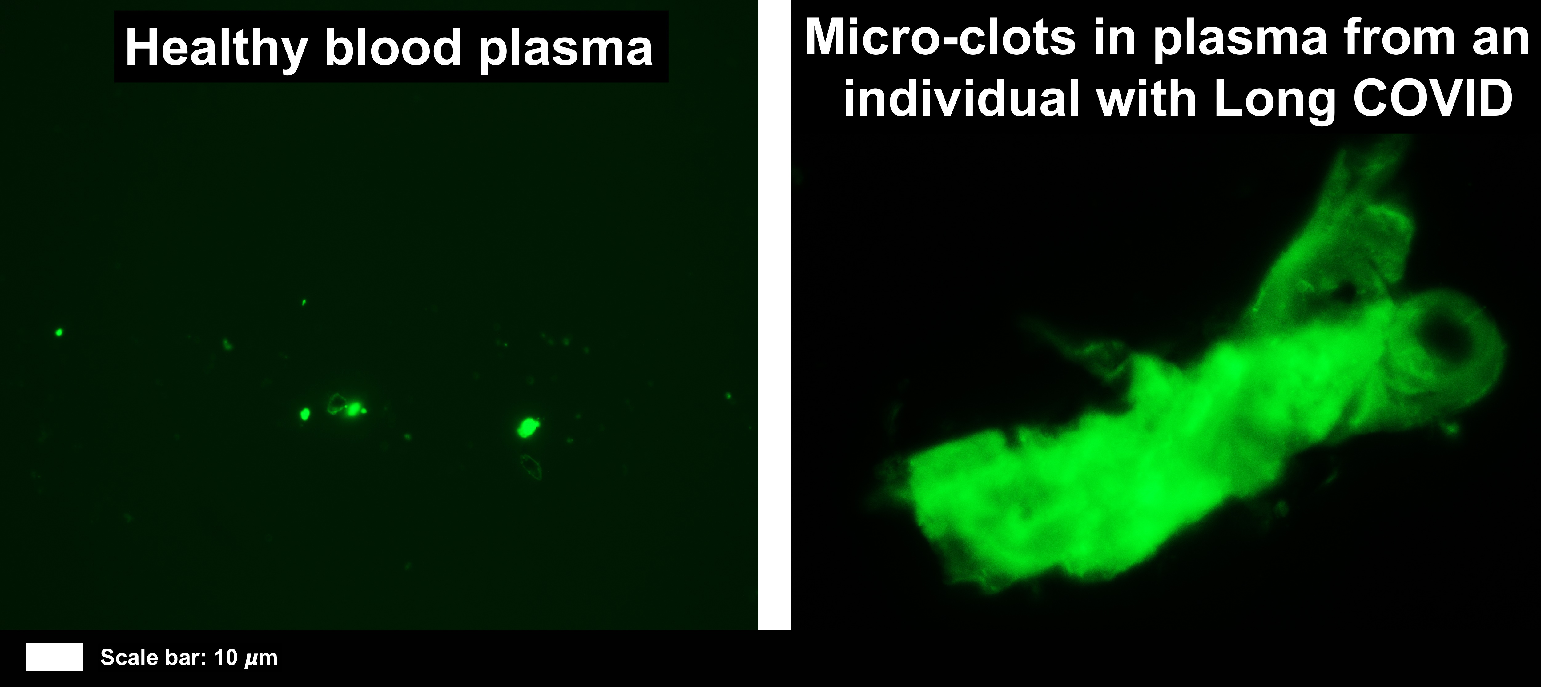 Covid-19, Covid-19 pandemic, Stellenbosch University, University of Stellenbosch, inflammatory molecules, blood-clots, Professor Resia Pretorius, long-Covid, long-Covid study