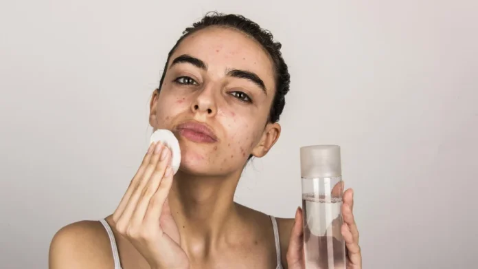 Woman cleans acne prone skin with toner and cotton pad