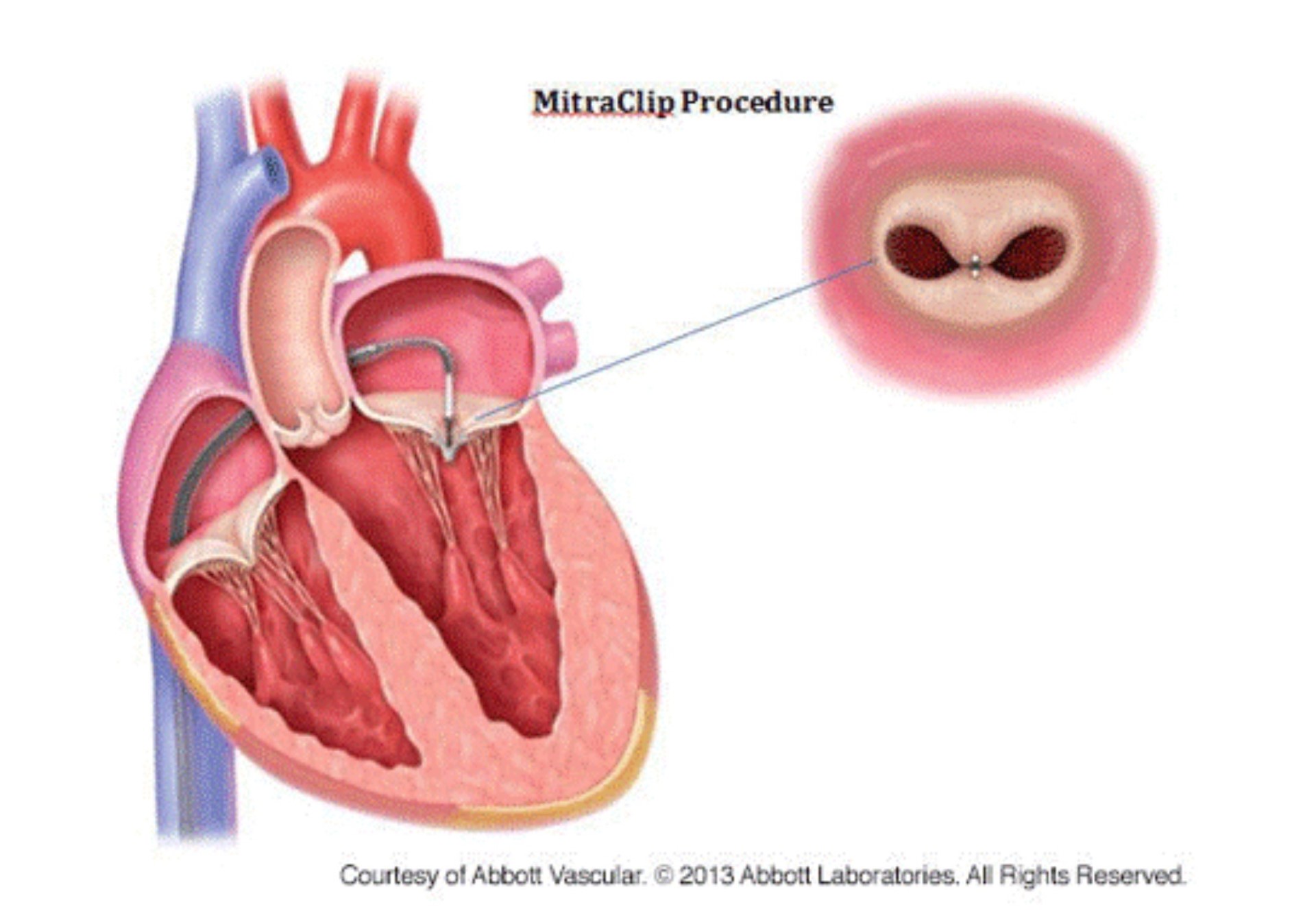 Implantation d'un clip sur la valve mitrale - Service de cardiologie - HUG