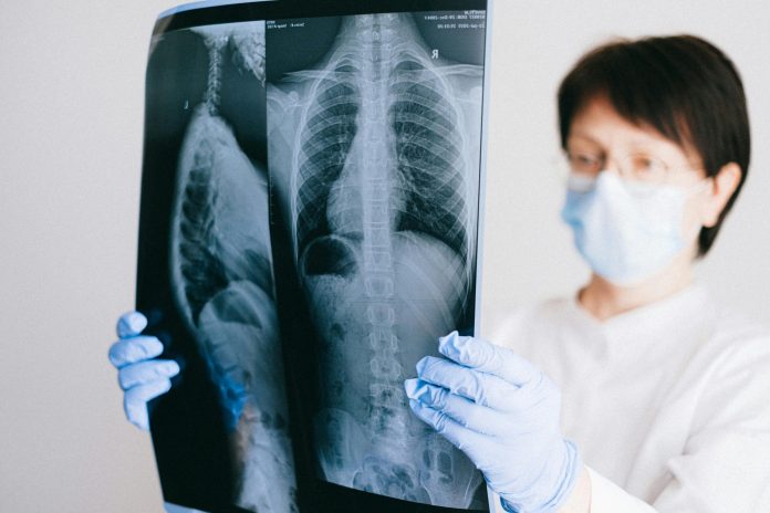 Lung problems persist in most adolescents even after TB treatment