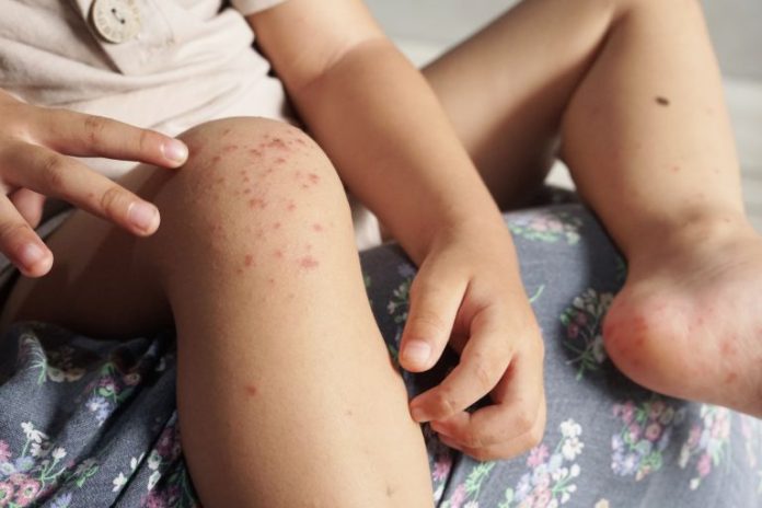 hand, foot and mouth disease