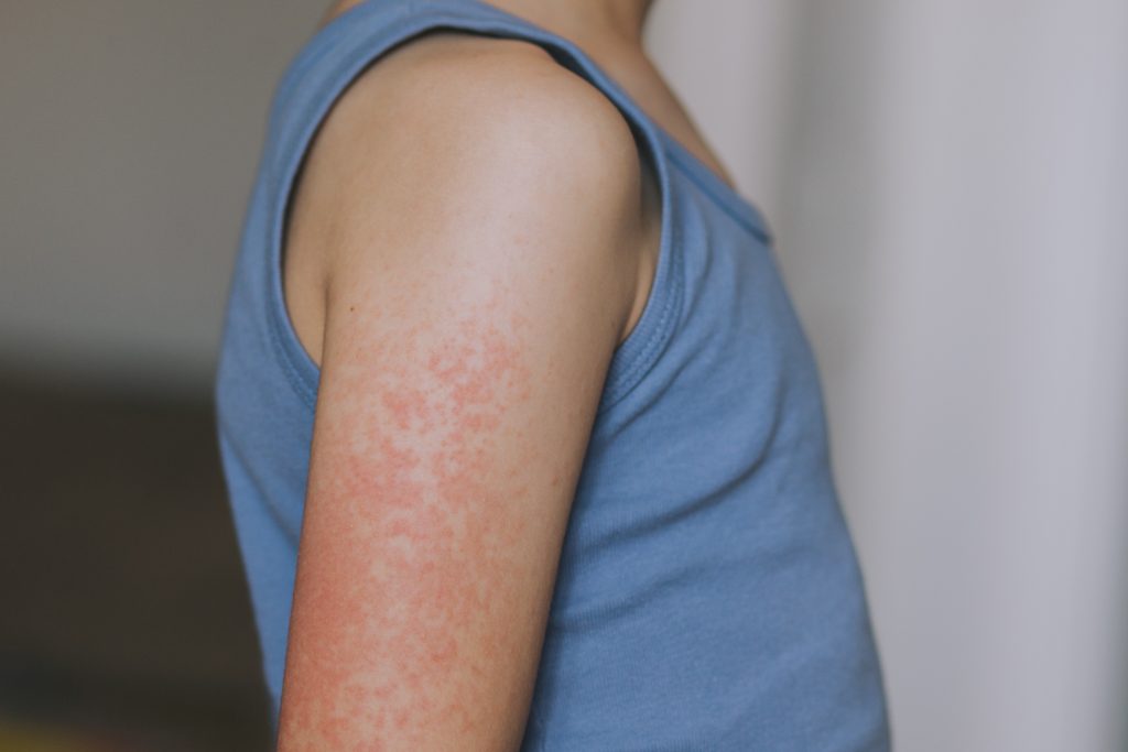 measles